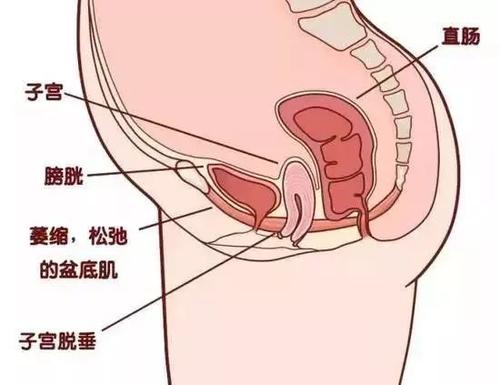 笑尿了如何让膀胱不失控
